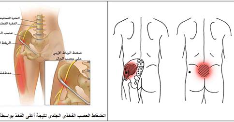 الوقاية والعلاج من آلام الظهر