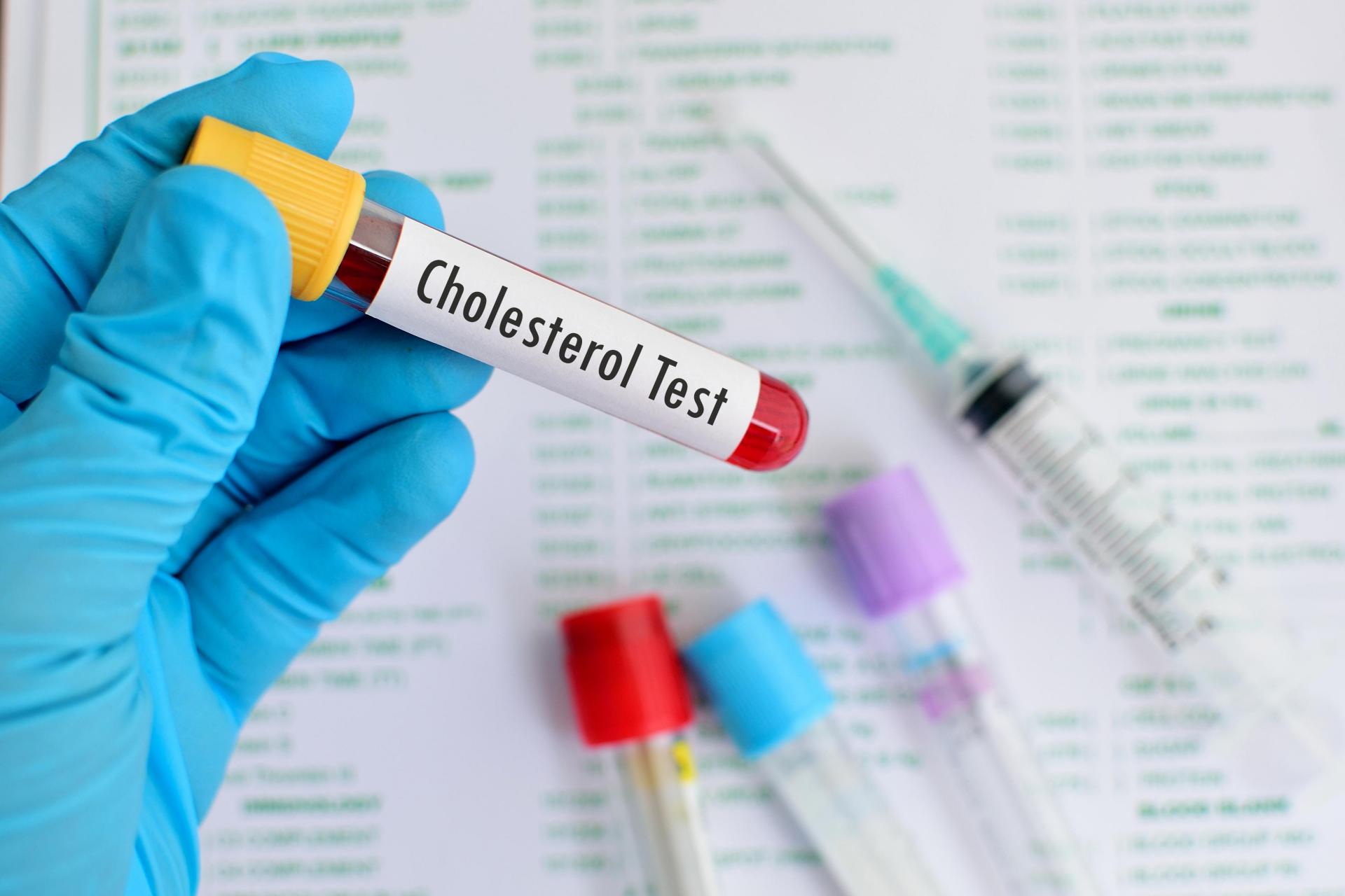 توصيات اختبارات مستوى الكوليسترول يجب تغييرها