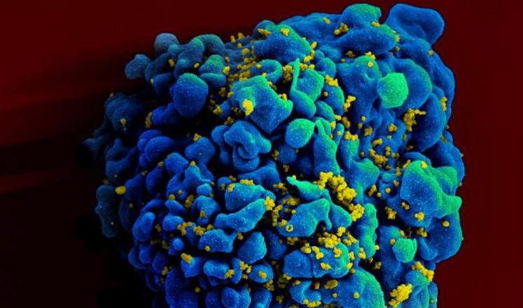 لأول مرة نجاح أجسام مضادة لفيروس الإيدز
