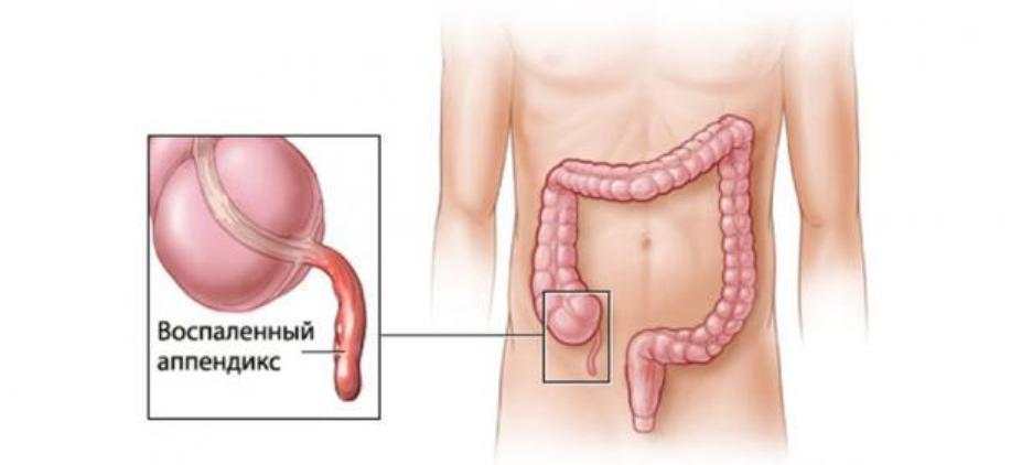 هذا هو الدور المهم لزائدة دودية Appendix